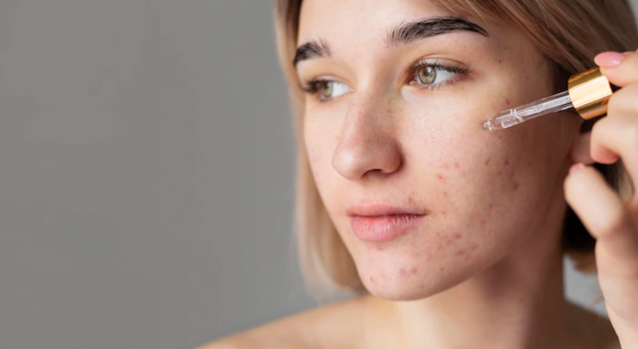 Better Beauty | Fight Acne Marks and Dark Spots with the Goodness of Alpha Arbutin